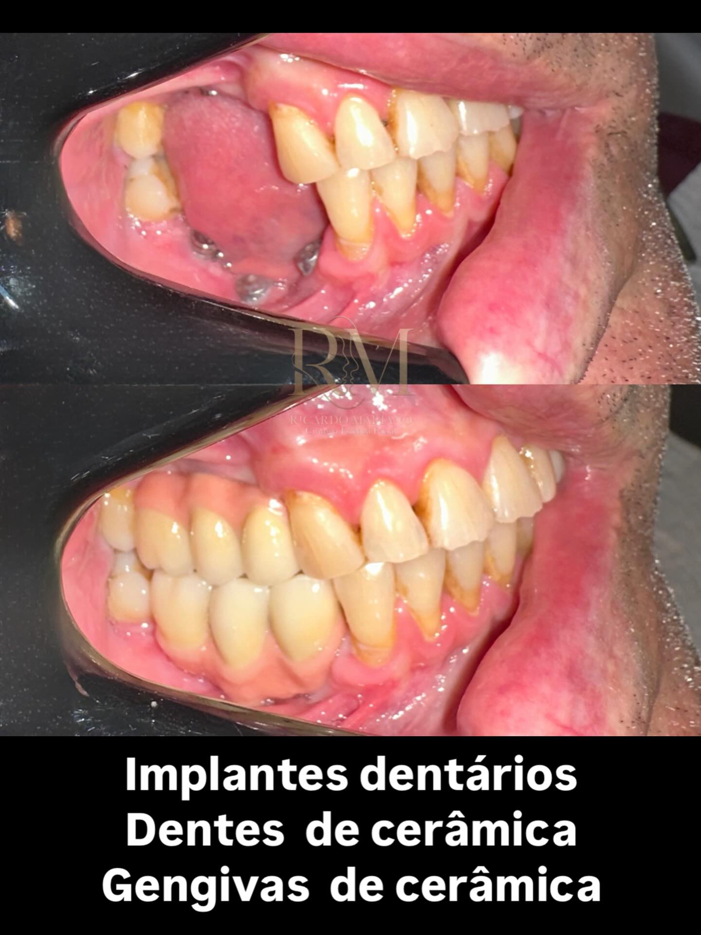 Implantes dentários com dentes e gengiva de cerâmica