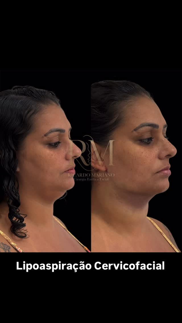 Lipoaspiração cervicofacial — antes e depois