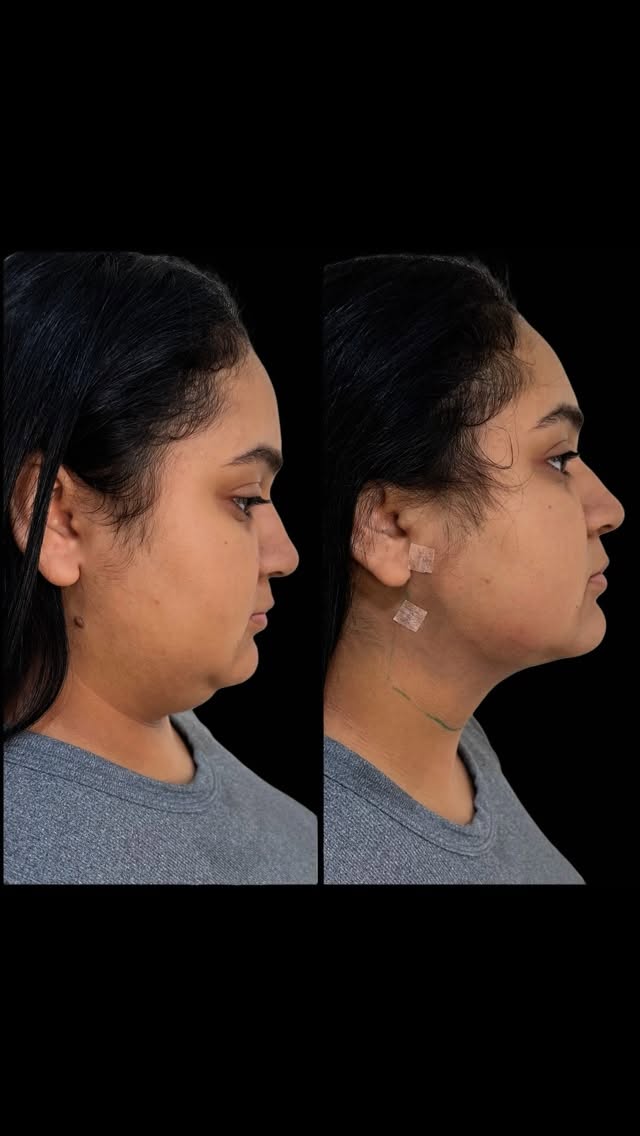 Contorno cervicofacial de perfil — antes e depois
