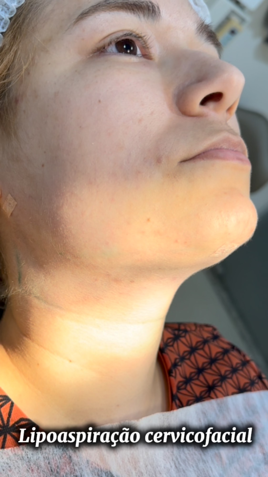 Lipoaspiração cervicofacial — resultado do contorno do pescoço