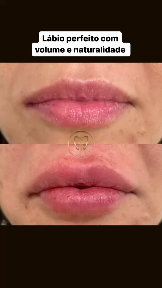 Preenchimento labial com volume natural