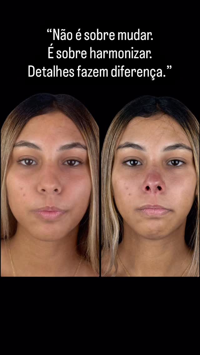Harmonização facial — antes e depois