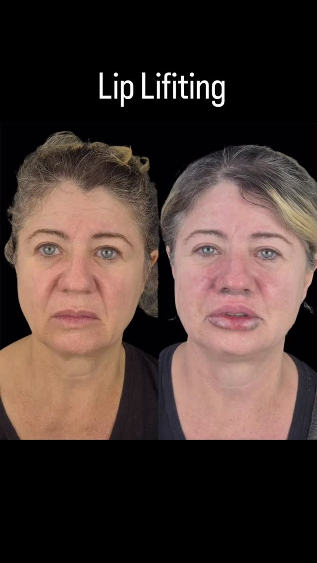 Lip lifting — antes e depois