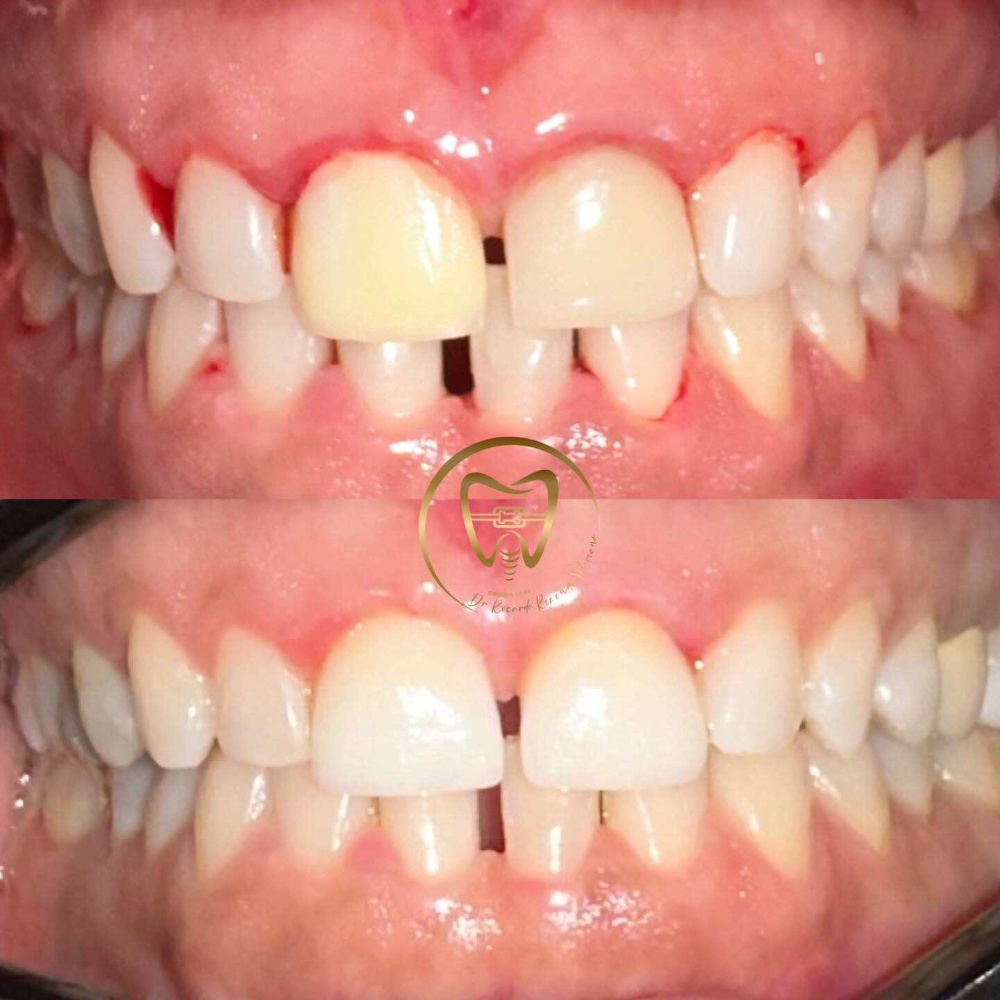Reabilitação estética dos dentes anteriores
