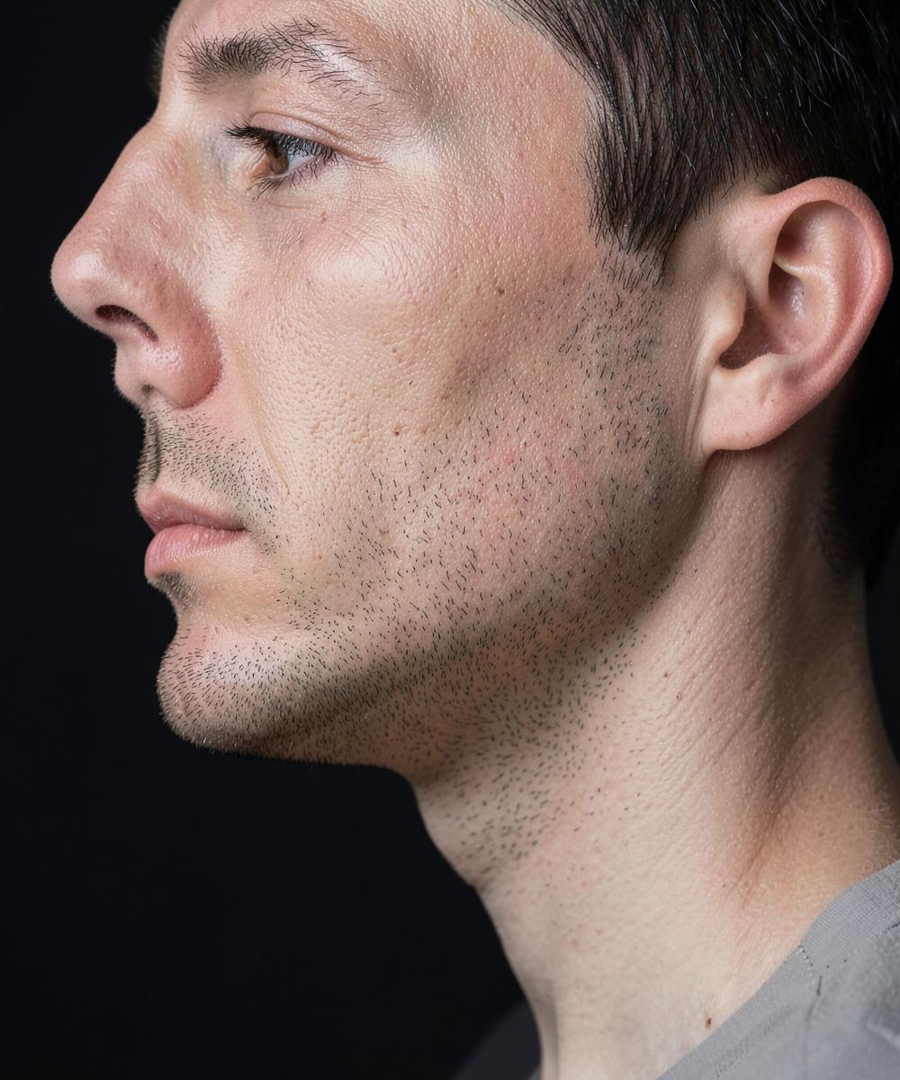 Caso de lipoaspiração cervicofacial — antes